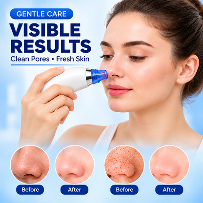 Electric Pore Vacuum Skin Cleaner – 4 in 1 Blackhead Remover, Pore Cleaner & Facial Skin Care Device